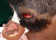 Polresta Ambon Belum Tangkap Pelaku Penganiayaan Bersama di Batu Meja, Padahal Korban Anak Dibawah Umur, Dipukul Pakai Kunci Motor