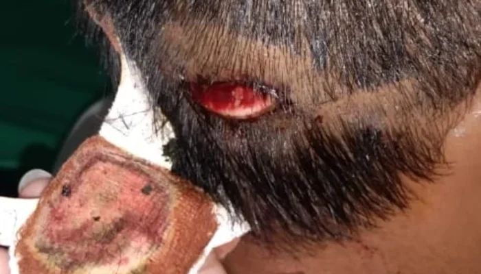 Polresta Ambon Belum Tangkap Pelaku Penganiayaan Bersama di Batu Meja, Padahal Korban Anak Dibawah Umur, Dipukul Pakai Kunci Motor